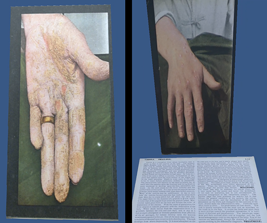 A still image of the stereoscope cards labeled “Eczema Chronicum Volae Manus and Variola,” as rendered in the Oculus Go virtual reality headset